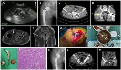 Case report: Formation and recurrence of inflammatory pseudotumor after metal-on-metal hip arthroplasty